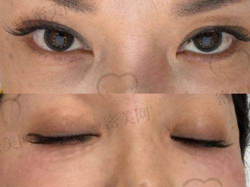 不同年龄段去泪沟的方法选择