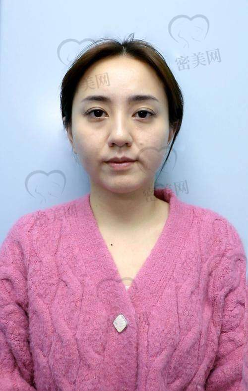 脸部填充的注意事项