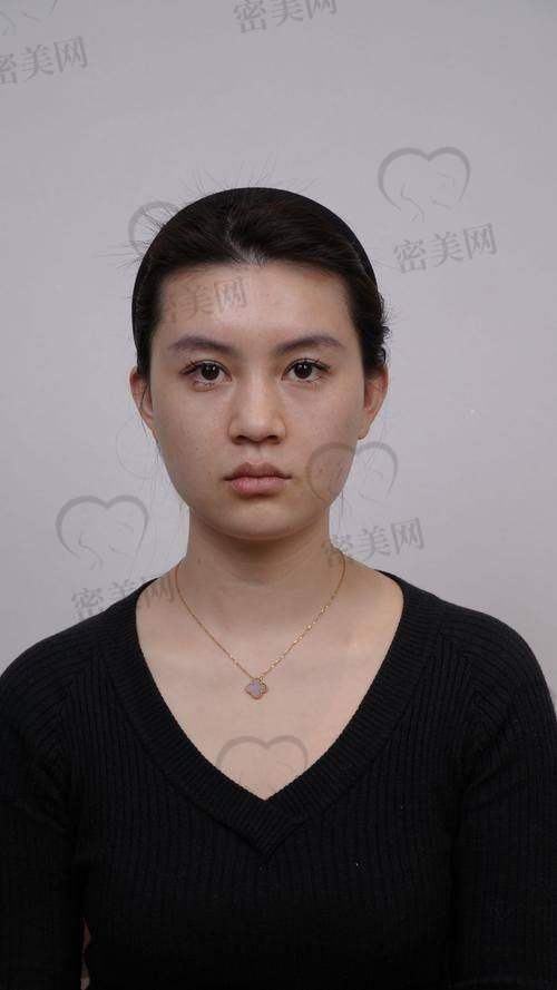 郭敬松面部填充美学的独特优势