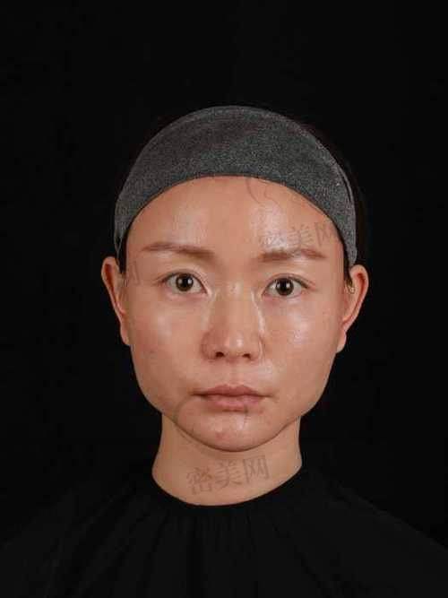 不同填充材料的费用分析