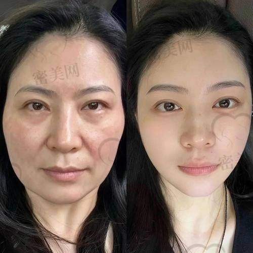 重庆松山医院李喆眼周筋膜提升：口碑爆棚