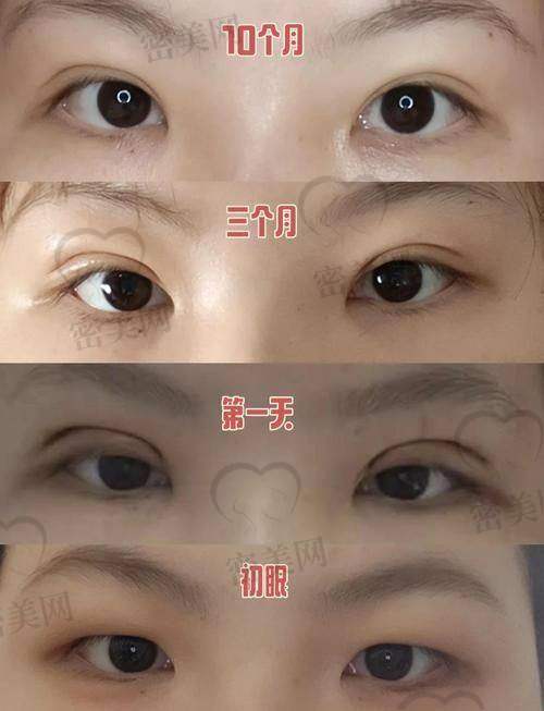 重庆华美紫馨：切开双眼皮的理想之选