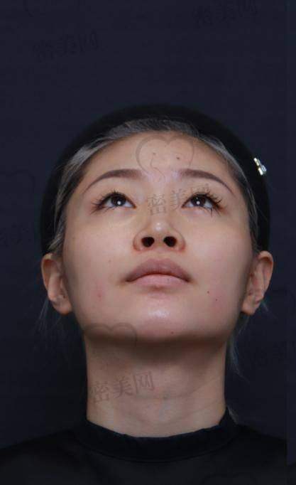 打完鼻子玻尿酸能否修复原状
