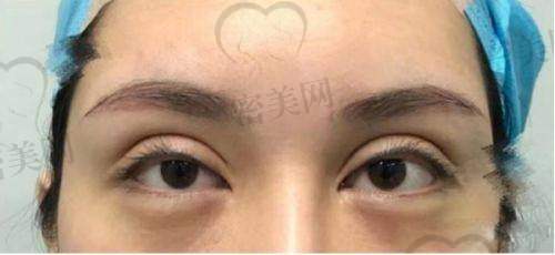 重庆美仑美奂董开云双眼皮修复：技术优势大揭秘