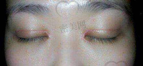 重庆美仑美奂董开云双眼皮修复：口碑爆棚的秘密