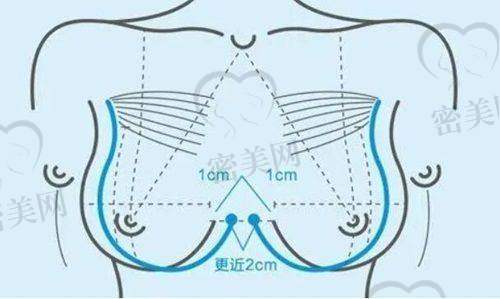 胸部整形费用详解