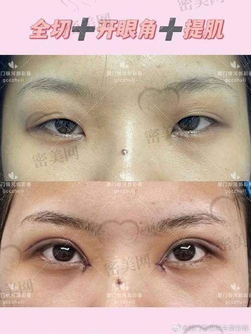 双眼皮修复、综合眼整形：王博谦的另一主攻场