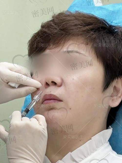 医美机构活动与玻尿酸去法令纹的性价比