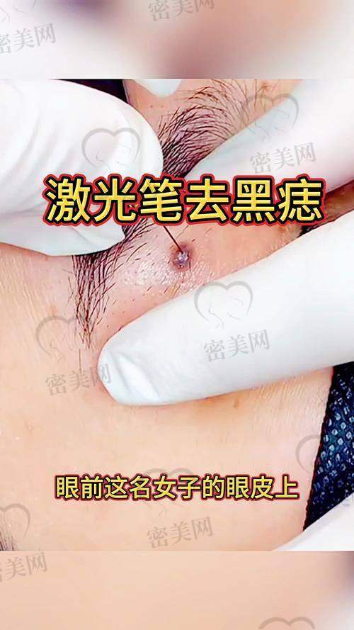 昆山点痣医院推荐一览表