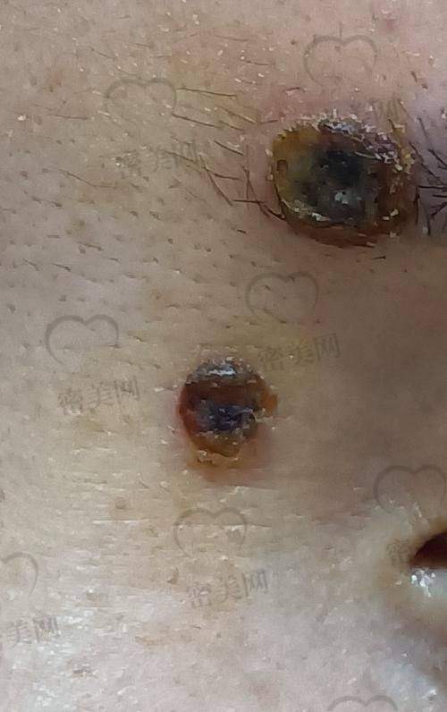 术前术后的费用也别忽略，真的不止一刀的事！