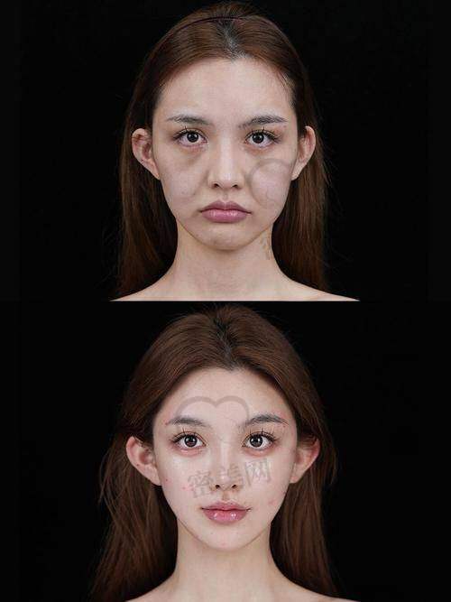 深圳美莱医疗美容医院——面部提升手术为什么这么火？