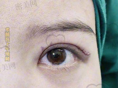 真实实例对比：从“毁眼”到“重生”的蜕变