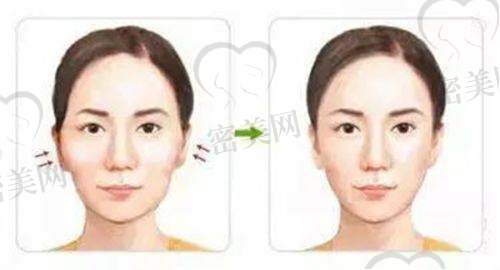 沈阳杏林颌面轮廓整形项目 | 改脸型价格区间是多少？