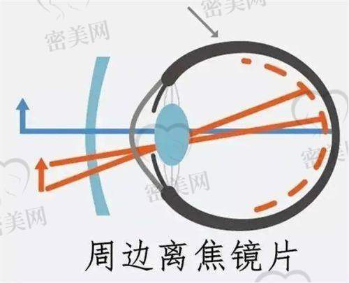 许昌华厦眼科医院近视手术价格透明合理，亲民不坑人