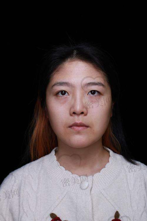 广州健丽医美祛眼袋多少钱？价格区间参考