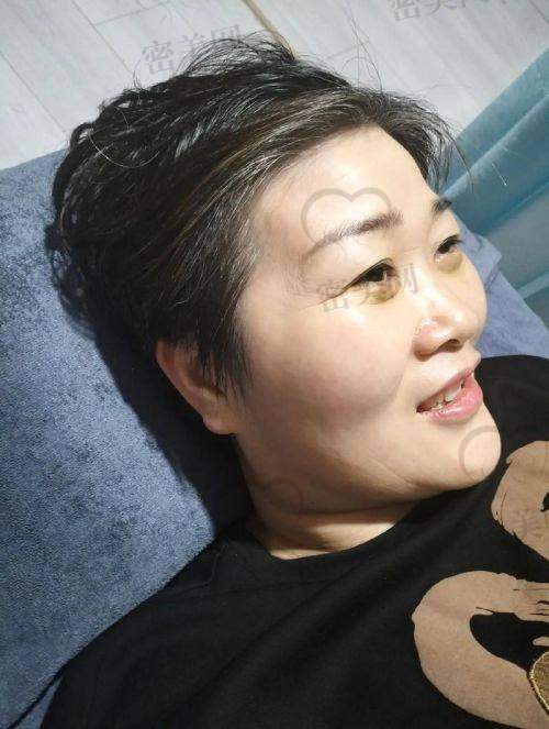 不只是视觉，太阳穴丰满后的这几个好处你想不到