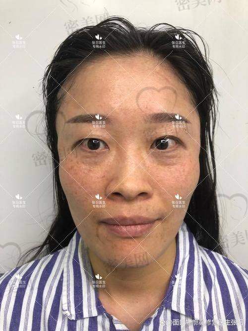 玻尿酸填充太阳穴：快狠准的轮廓急救方案