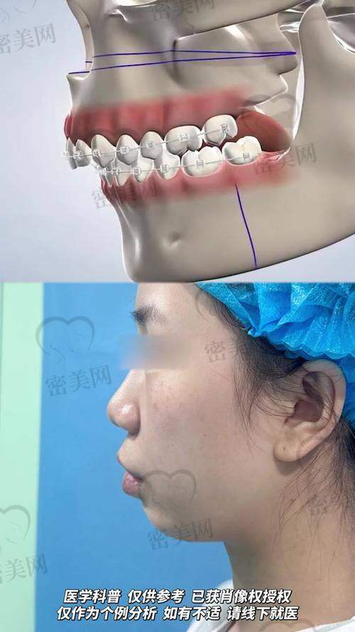 如何降低在八大处做正颌的整体支出？一定要看完这几个省钱技巧