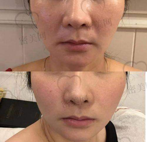 韩国医美机构及实例对自体脂肪填充的启示