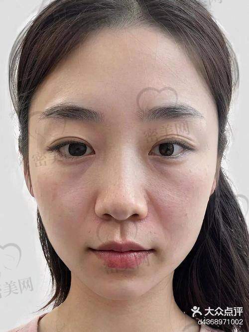 法令纹费用参考表格