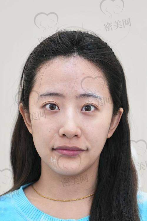 注射玻尿酸去除法令纹的副作用