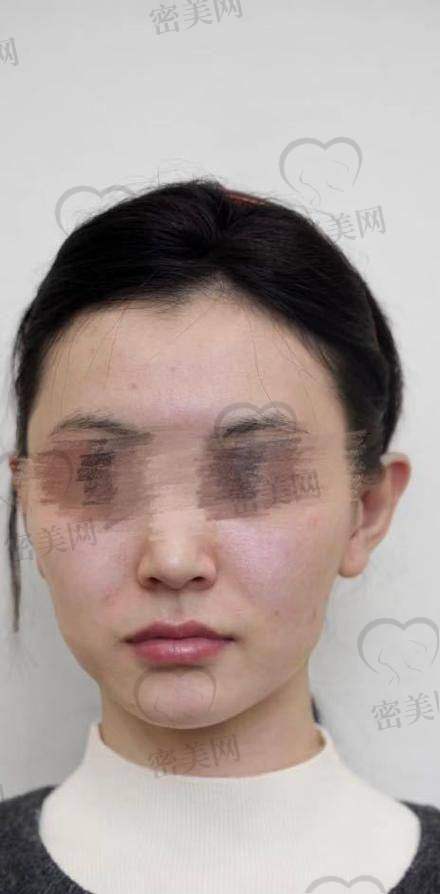 重庆松山医院李喆SMAS深筋膜埋线提升：优势特色大揭秘！