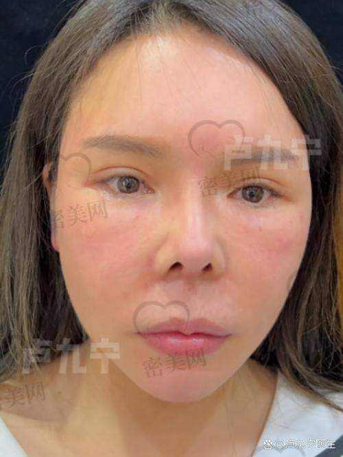 深圳贝漾美天医疗美容：曹思佳医生擅长动态人中审美塑形