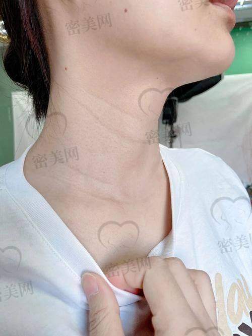 嗨体去颈纹的价格因素