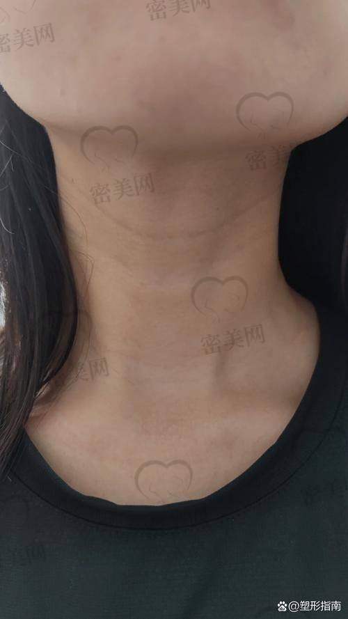 嗨体去颈纹的治疗过程