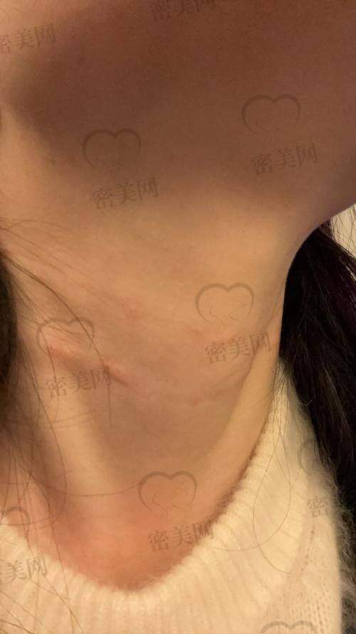 挑选技巧：看你的颈纹类型和“时间预算”