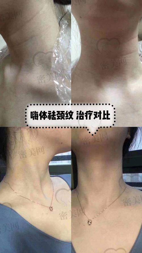 嗨体1.5和2.5的区别