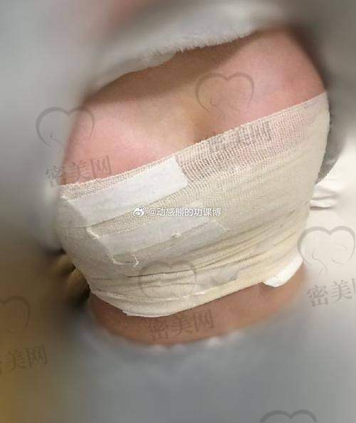 听听大家对重庆星荣整形外科医院假体丰胸的评价