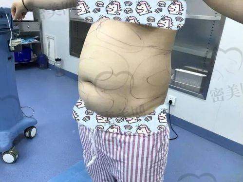 重庆当代整形外科医院黄鲜吸脂：真人实例见证奇迹