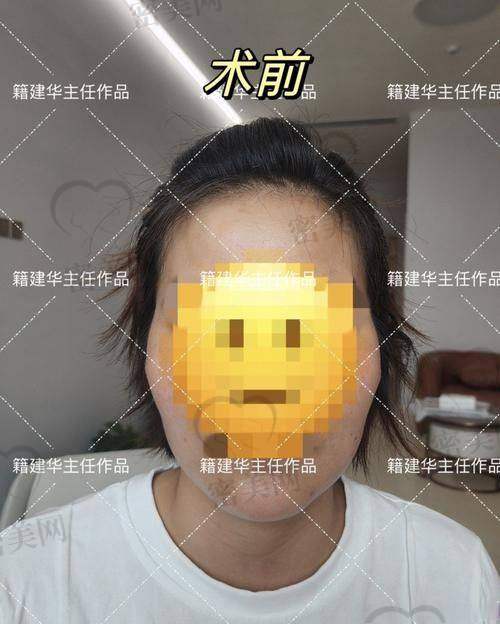 影响下巴整形价格的因素