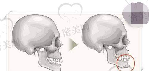 不同地区下巴整形价格参考