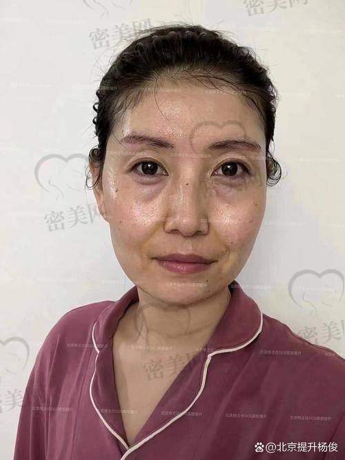 重庆松山医院李喆SMAS深筋膜埋线提升：口碑爆棚的变得更美秘籍！