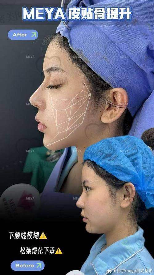 重庆松山医院李喆：39800起的SMAS深筋膜埋线提升，价格超美丽！