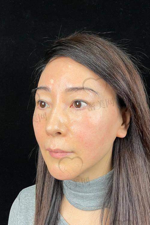 体验陈凤超苹果肌提升过程