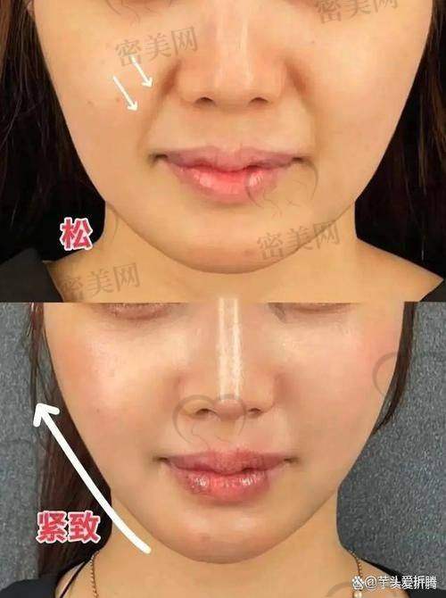 自体脂肪填充面部和胸部的维持时间