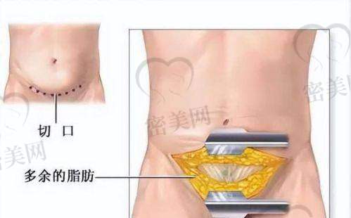 重庆星荣整形外科医院刘正茂：16800 元起，腹壁成型的亲民价！