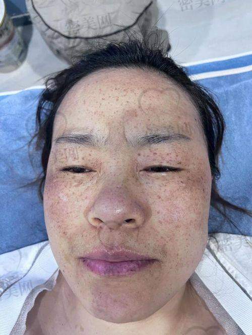 小贴士：治疗激光祛斑后，这几点医生会特别提醒