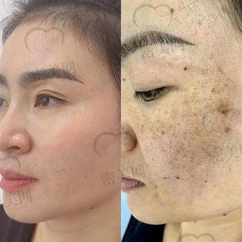 点阵激光疗程与优惠政策揭秘——实惠又稳妥