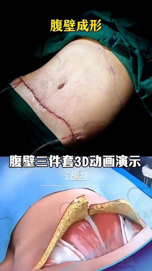 重庆星荣整形外科医院刘正茂腹壁成型：口碑爆棚，好评如潮！
