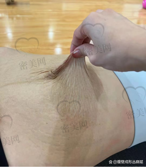 重庆星荣整形外科医院刘正茂腹壁成型：真人实例见证奇迹！