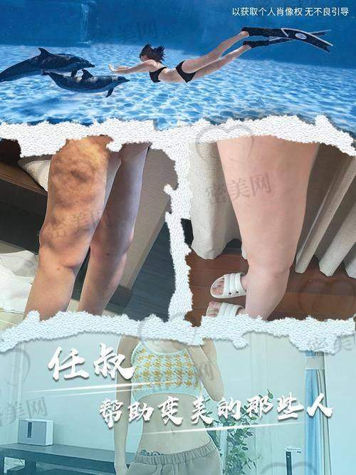 张雪峰：疤痕体质专属，安心吸脂不留印
