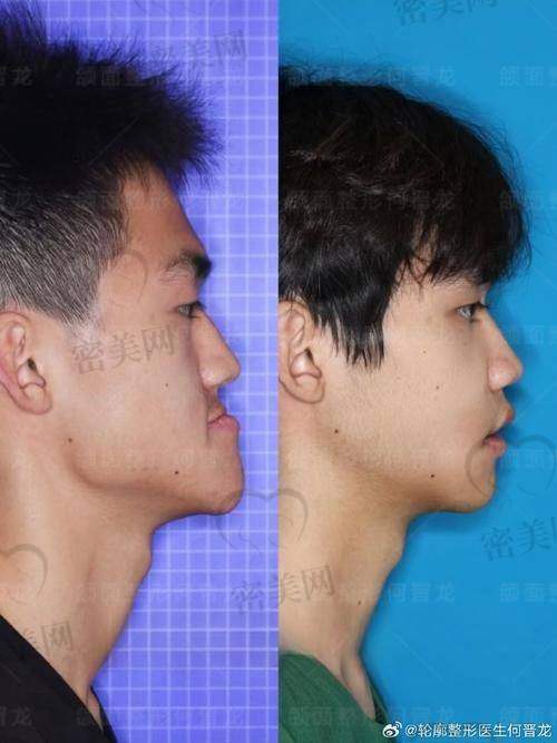 1. 看牙齿咬合：是轻冲还是深包？
