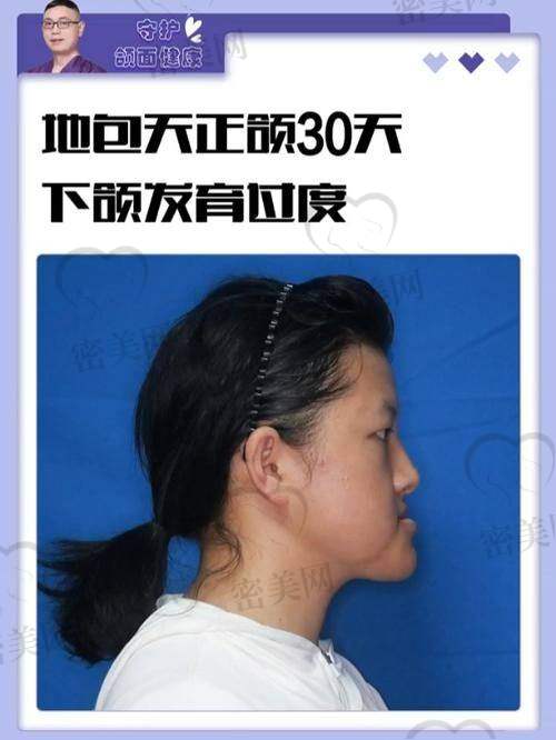 ? 轻度地包天怎么改？