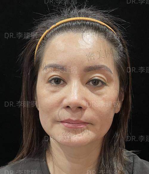 避开馒化脸修复的坑，一定要看清这几点