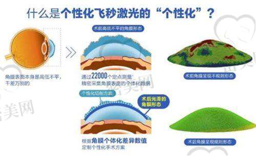 吉大二院眼科医院2025年近视激光手术价格大全