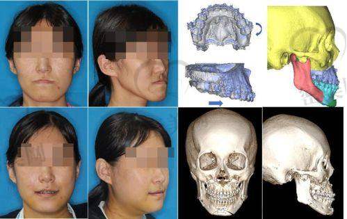 重庆松山医院肖林正颌：78000 起的美丽敲门砖